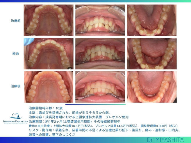 湘南鎌倉歯科・矯正歯科｜小児矯正の症例