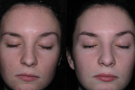 chemical-peels-10-front-detail_edited.jp