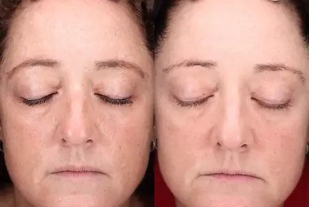 chemical-peels-202-front-detail.webp