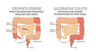 Maladies chroniques inflammatoires de l'intestin