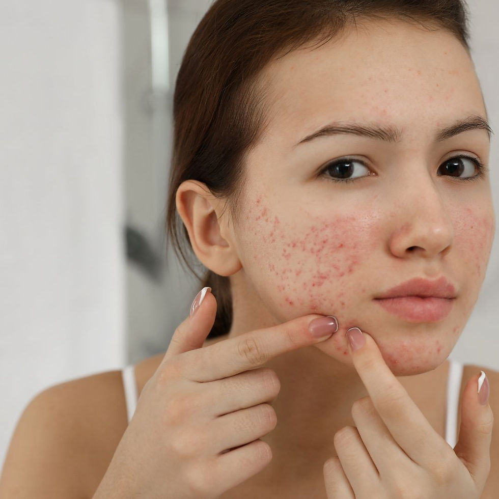 Conventional treatments often present potential adverse side effects and increasing antibiotic resistance, highlighting the need for new, natural, and safe acne therapies. One such promising treatment is Cannabidiol (CBD).