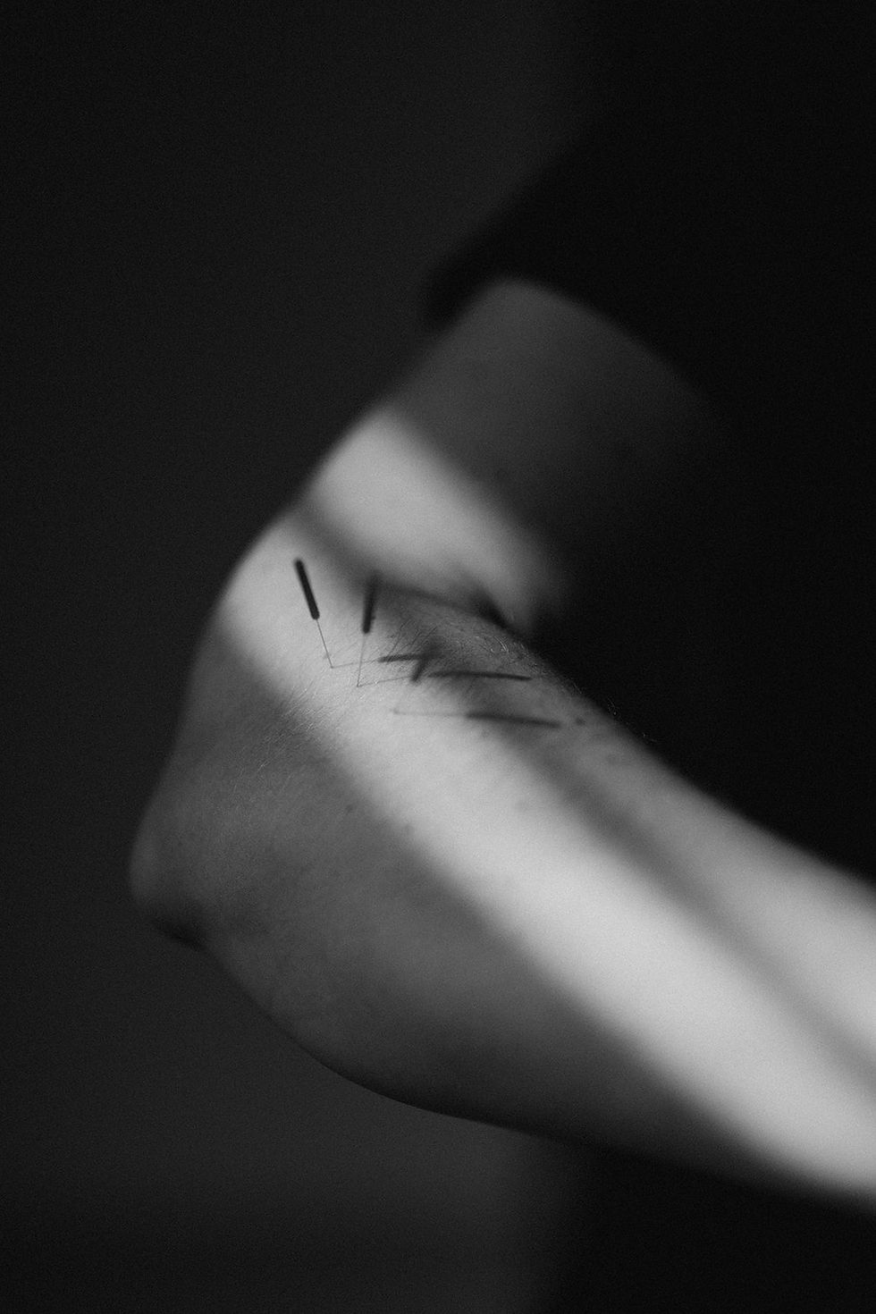dry needling