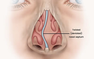 Nose Blockage
