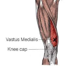 Irish dance strength and conditioning, dancer knee pain, vmo dips, knee pain from dancing, ballet knee pain, knee pain after dancing, vmo dips, how to avoid knee pain while dancing, preventing knee pain for dancers