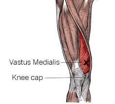 Vmo Alleviate Knee Pain and Increase it’s Stability with VMO Dips