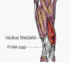 Irish dance knee pain