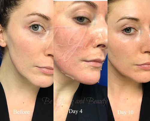BQCELL DERMA SKIN PEELING & RECELL CURE AMPULE SET FREE