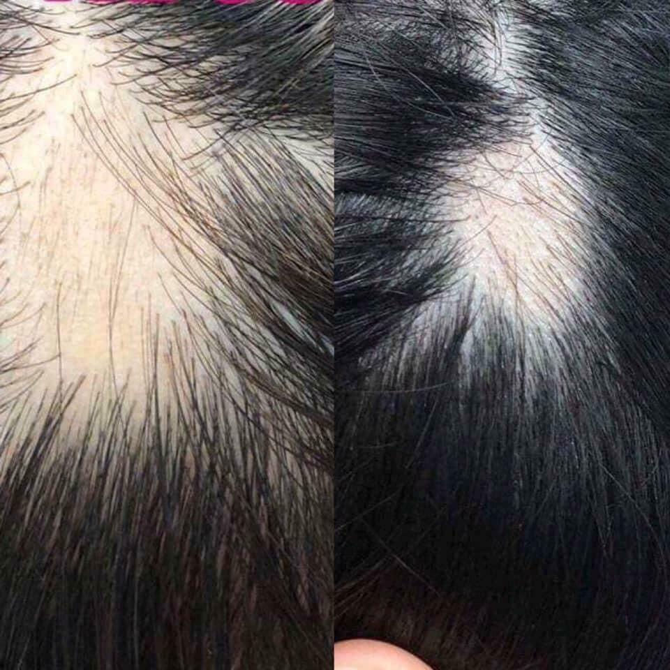 Thumbnail: Sato Carpronium Chloride Solution 5% 30ml Hair Fall Tonic Made In Japan