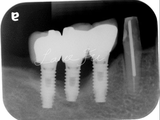 治療牙周病好麻煩，拔掉植牙C/P植比較高啦！且慢，你是否以為植牙不會生病？