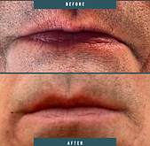 juvederm-2.png