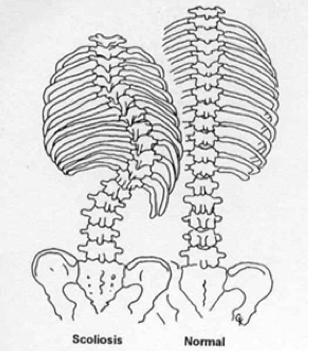 Scoliosis vs, normal spine
