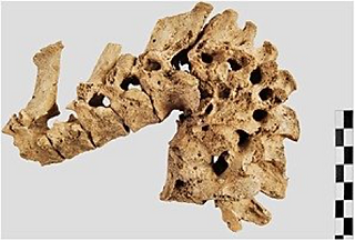 Spinal tuberculosis