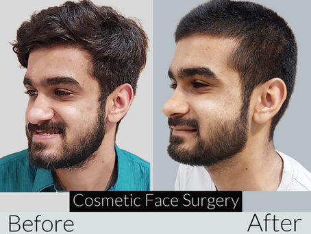 Transformative Journey: A Remarkable Underbite Treatment at Aldaim Dental Center