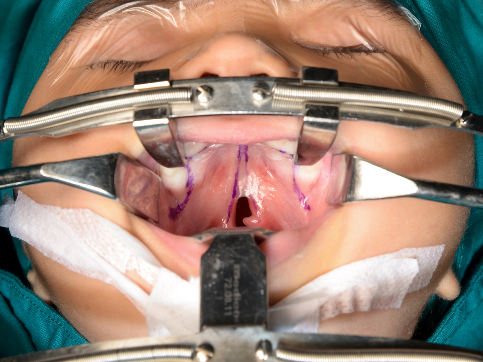 A child with a cleft palate, prepared for cleft palate repair surgery