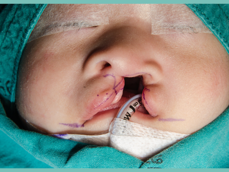 A Comprehensive Guide to Cleft Lip and Palate Care for Your Little Warrior
