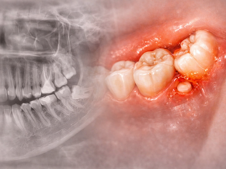 dente do siso inflamado