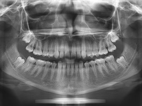 Dentes do siso: Aqui está o motivo para você removê-los