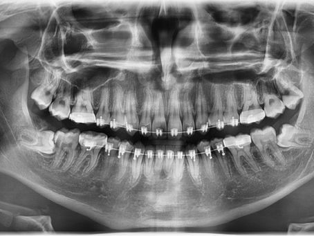 Dente do Siso: O que é, Sintomas, Extração e Cuidados Pós-operatórios