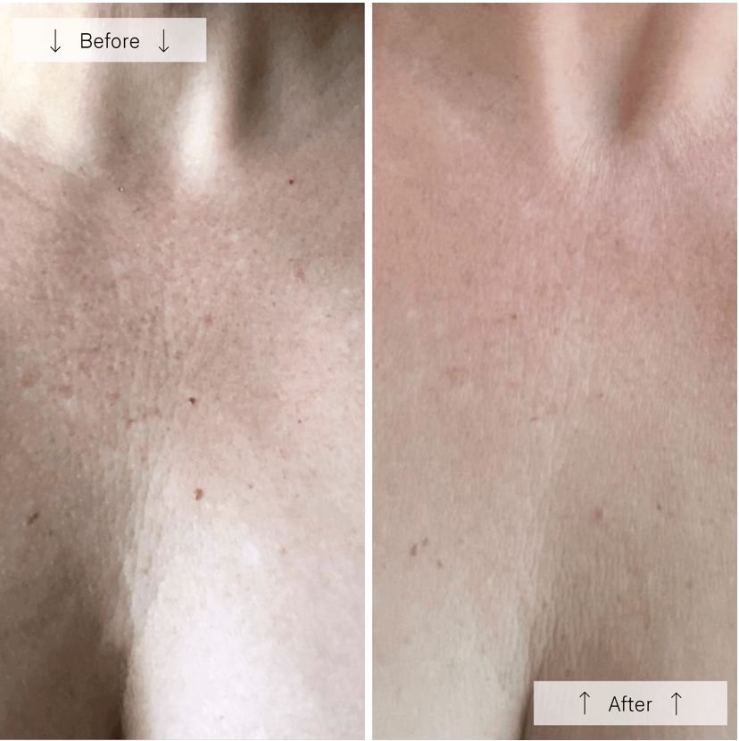 Thumbnail: Omnilux Contour Neck & Décolleté