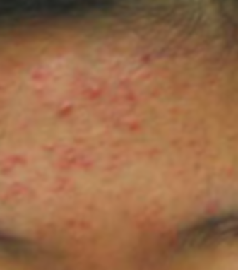 Acne Before