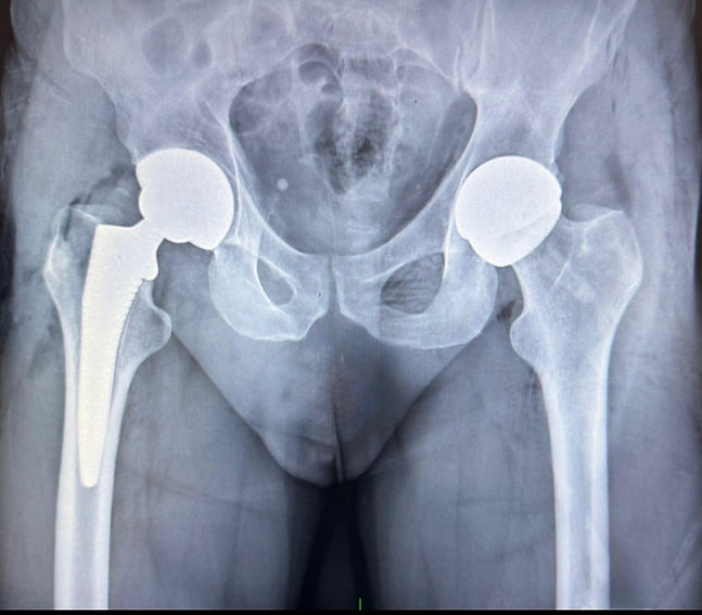 Hip Resufacing Dr Mike Millar.