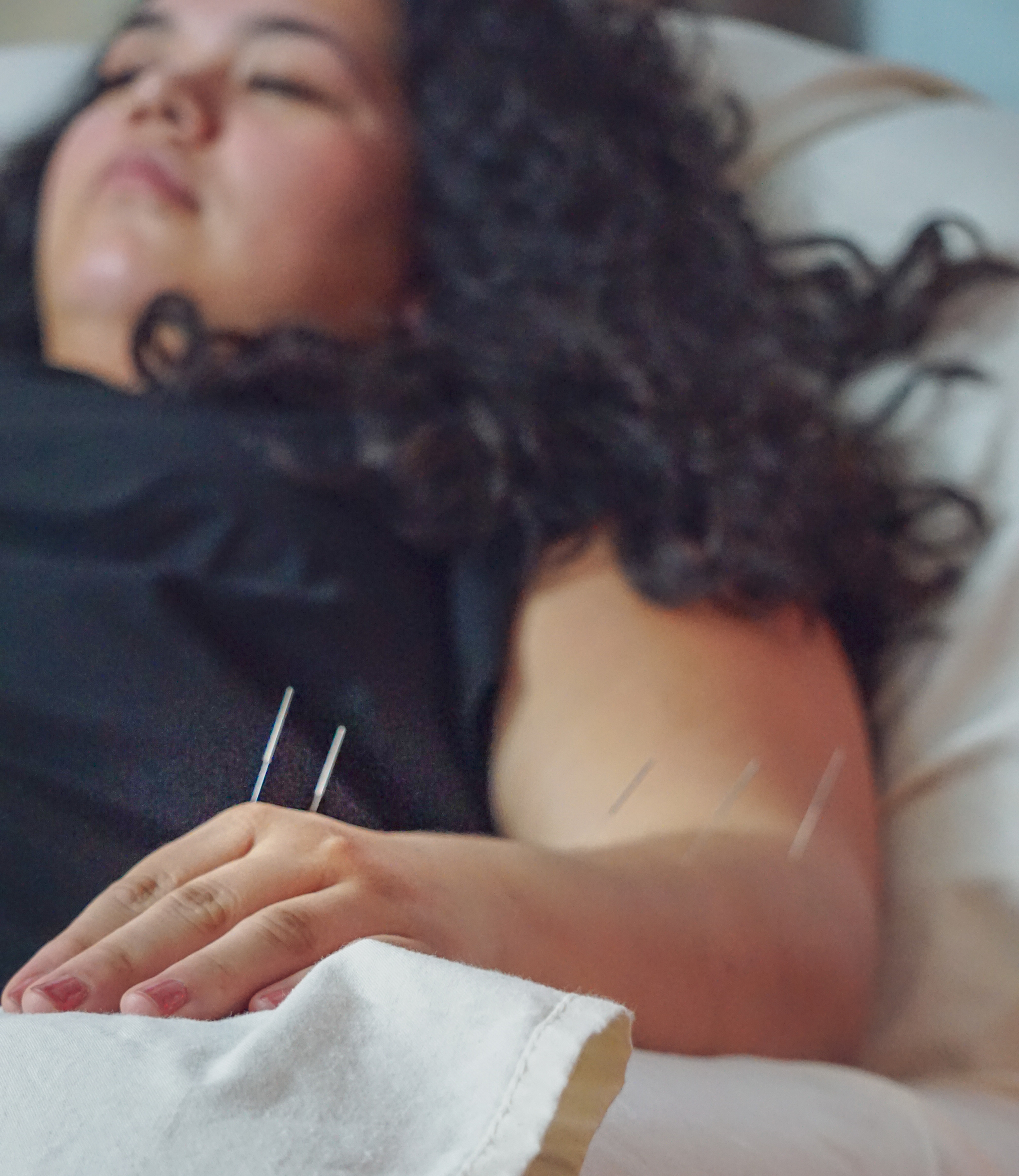 Woman resting with eyes closed as acupuncture needles are placed on her hand and head, in a calm setting.