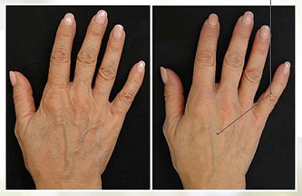 Profhilo Hands Before & After.jpeg