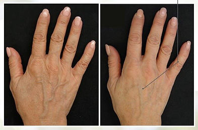 Profhilo Hands Before & After.jpeg