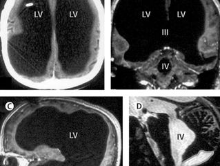 NO BRAINER: HOW APHANTASIA IS LIKE ATHEISM