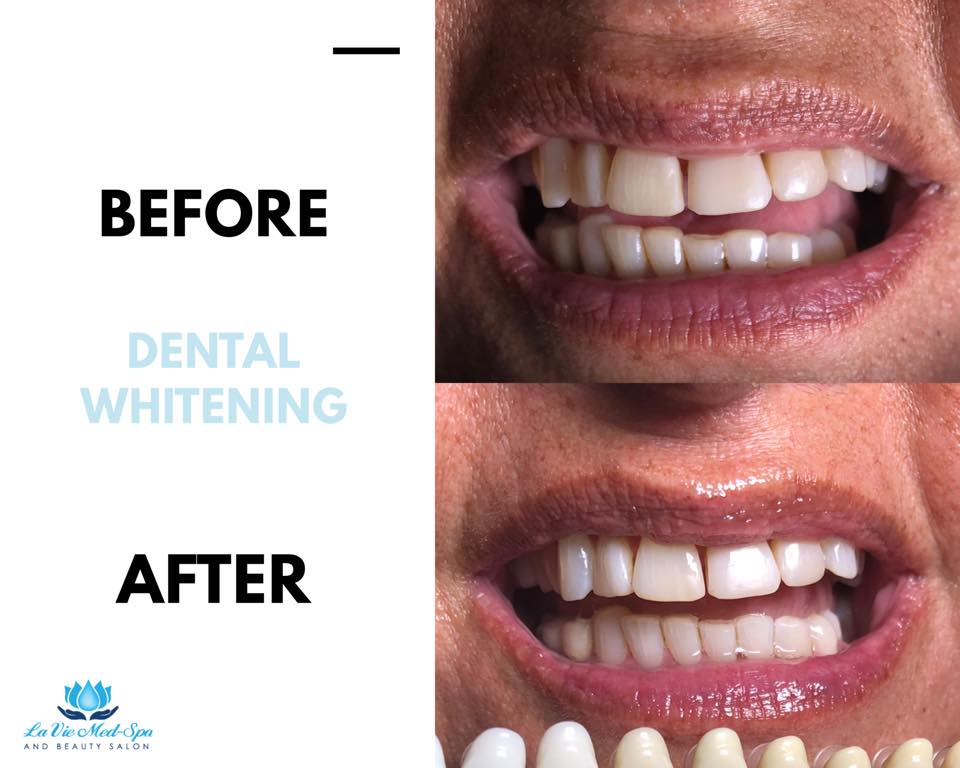 Dental whitening