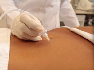 Carboxiterapia