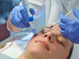 Microneedling o Dermapen