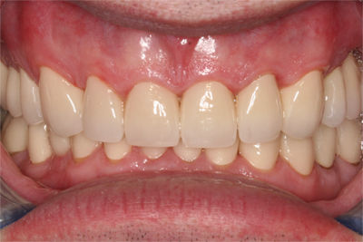 Patient 6 after
