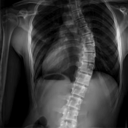 Scoliosis xray small.png