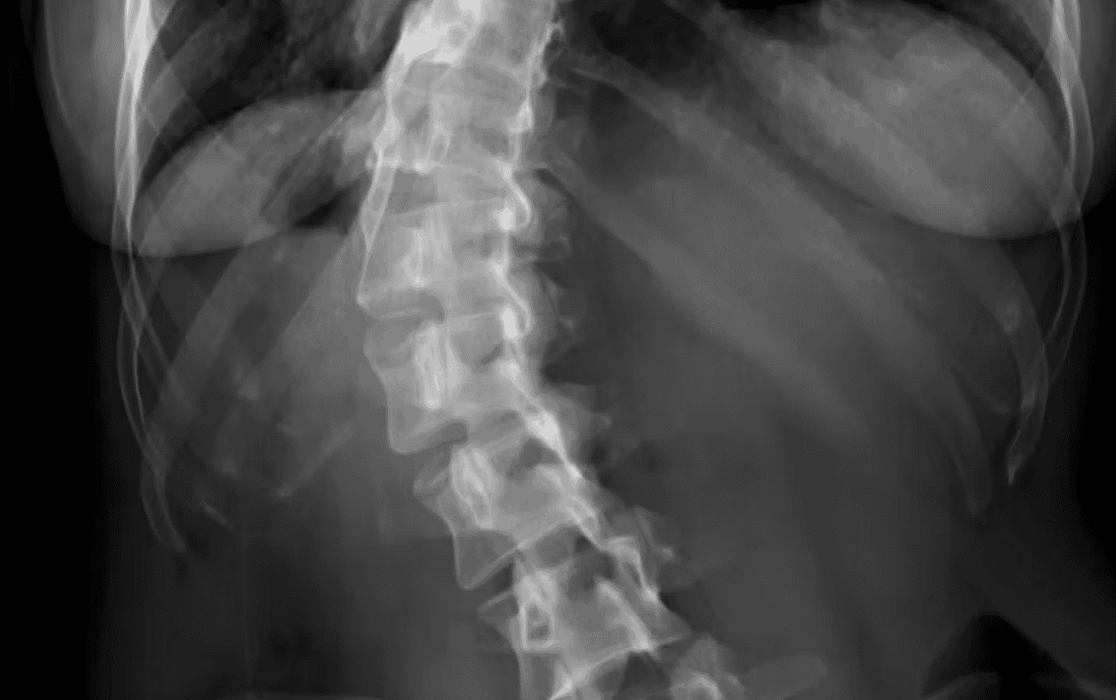 Scoliosis xray.png