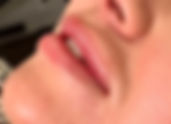 Lip Filler