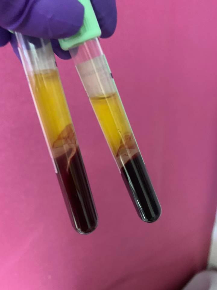 test tubes containing blood that has been separated to extract plasma