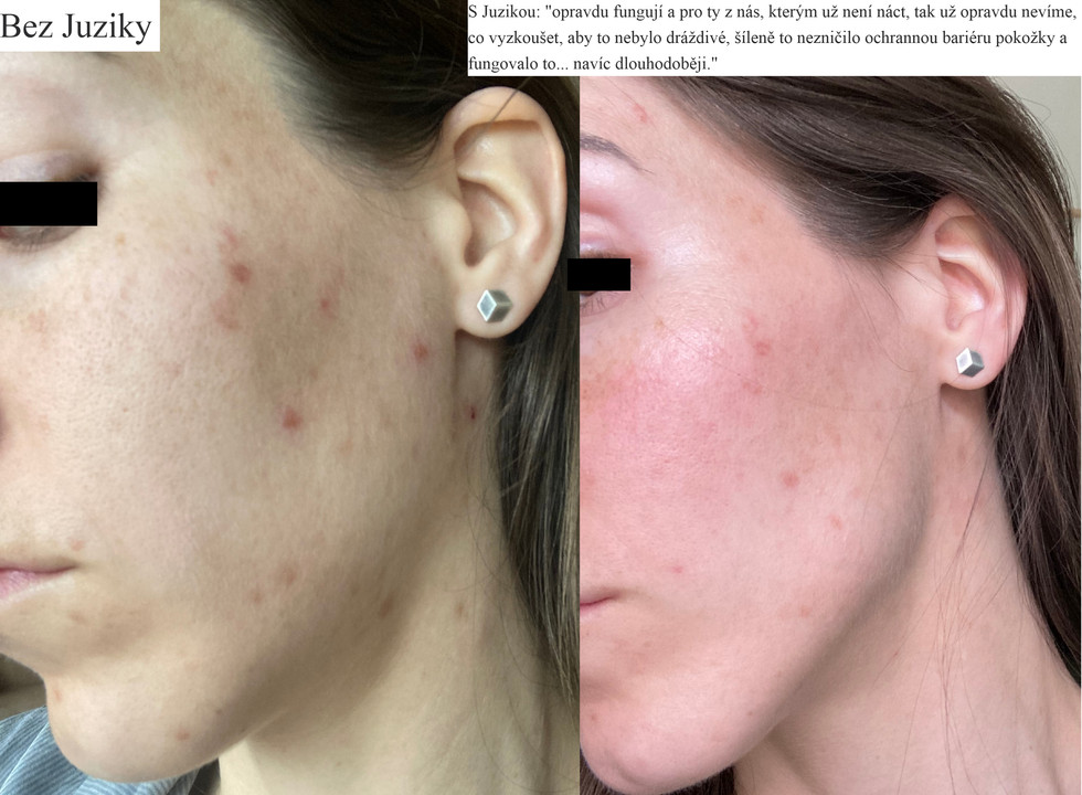 Juzika recenze - Akné proměna