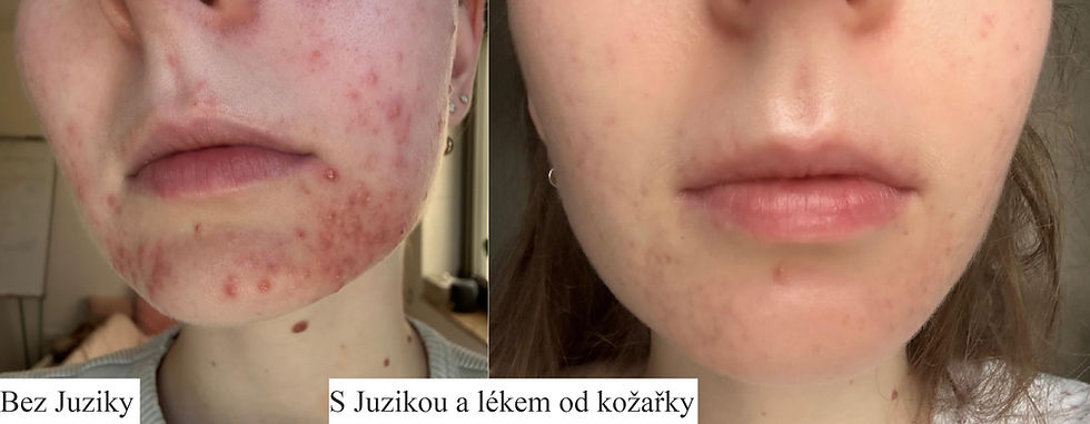 Juzika akné proměna