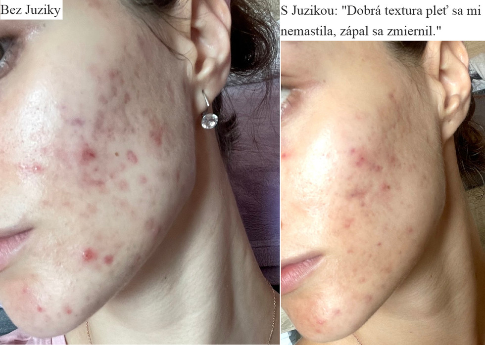 Juzika recenze - Akné proměna