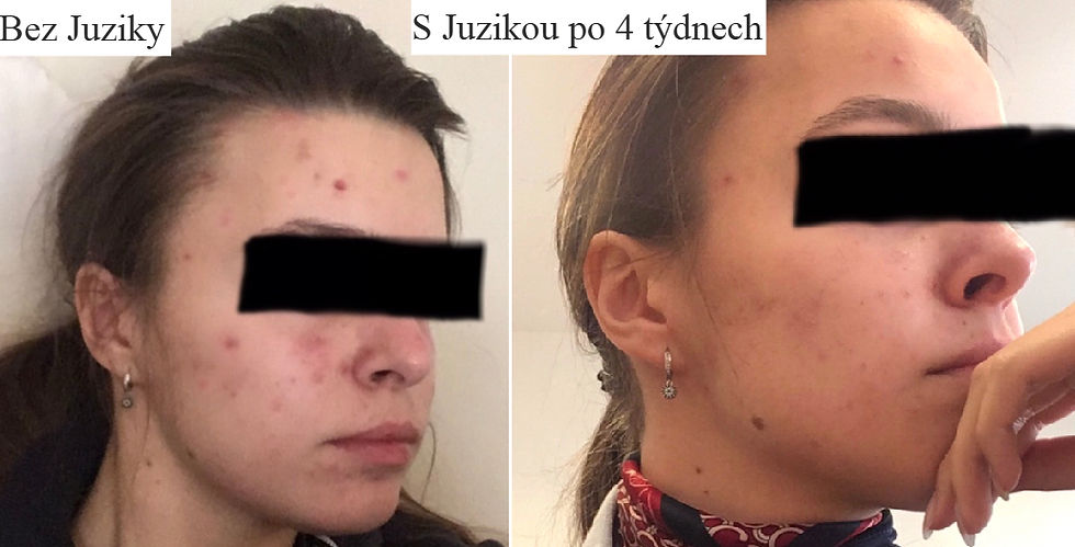 Juzika proměna s Gelem a Krémem proti akné - akné duo