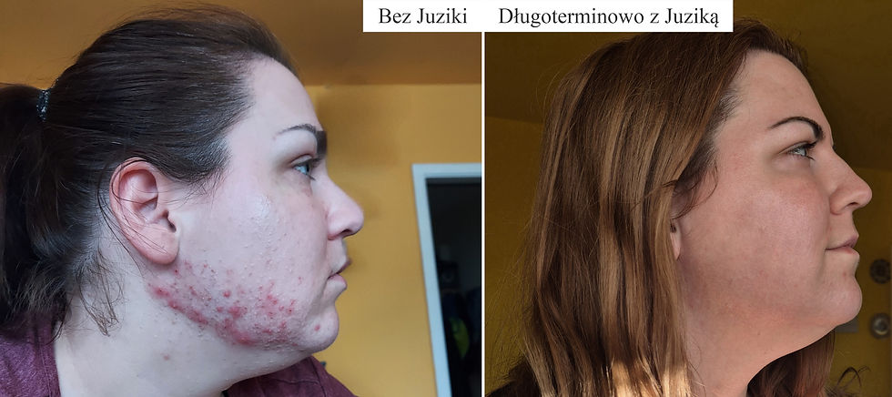Kobieta w dwóch ujęciach z profilu. Po lewej: skóra z wypryskami. Po prawej: wygładzona skóra. Tło pomarańczowe, napisy "Bez Juziki" i "Długoterminowo z Juziką".
