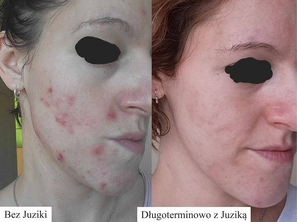 Porównanie cery twarzy: lewa strona z trądzikiem, prawa gładka. Napisy "Bez Juziki" i "Długoterminowo z Juziką".