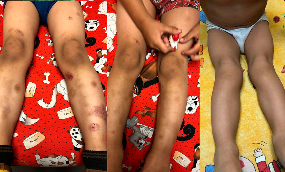 Casos Antes y Despues Alergias Piel11