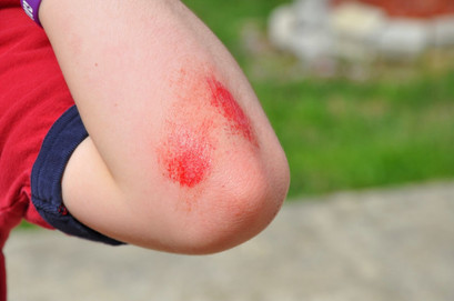 Kid with scrape.jpeg