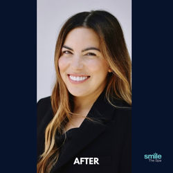 smile-the-spa-veneers