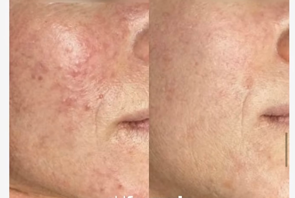 soin phformua contre les rougeurs