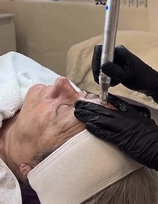 micro stimulation et infusion d'actifs