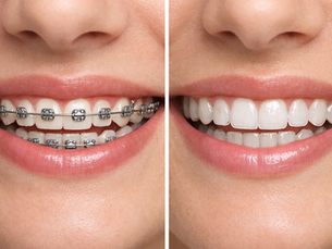 Braces vs Invisalign