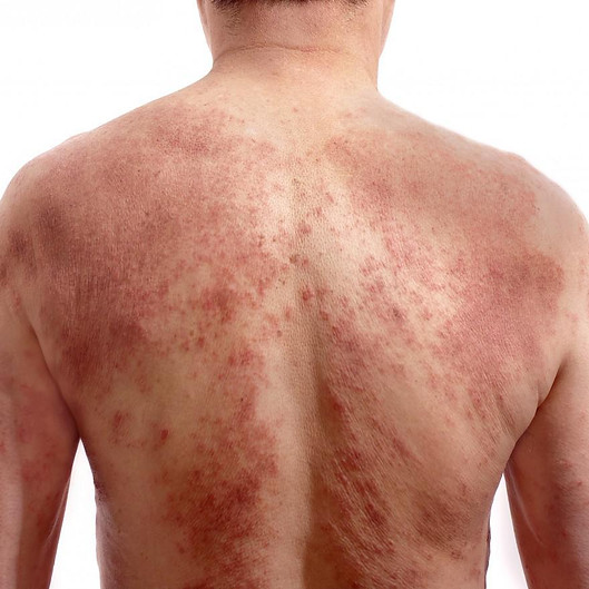 Skin rash, eczema